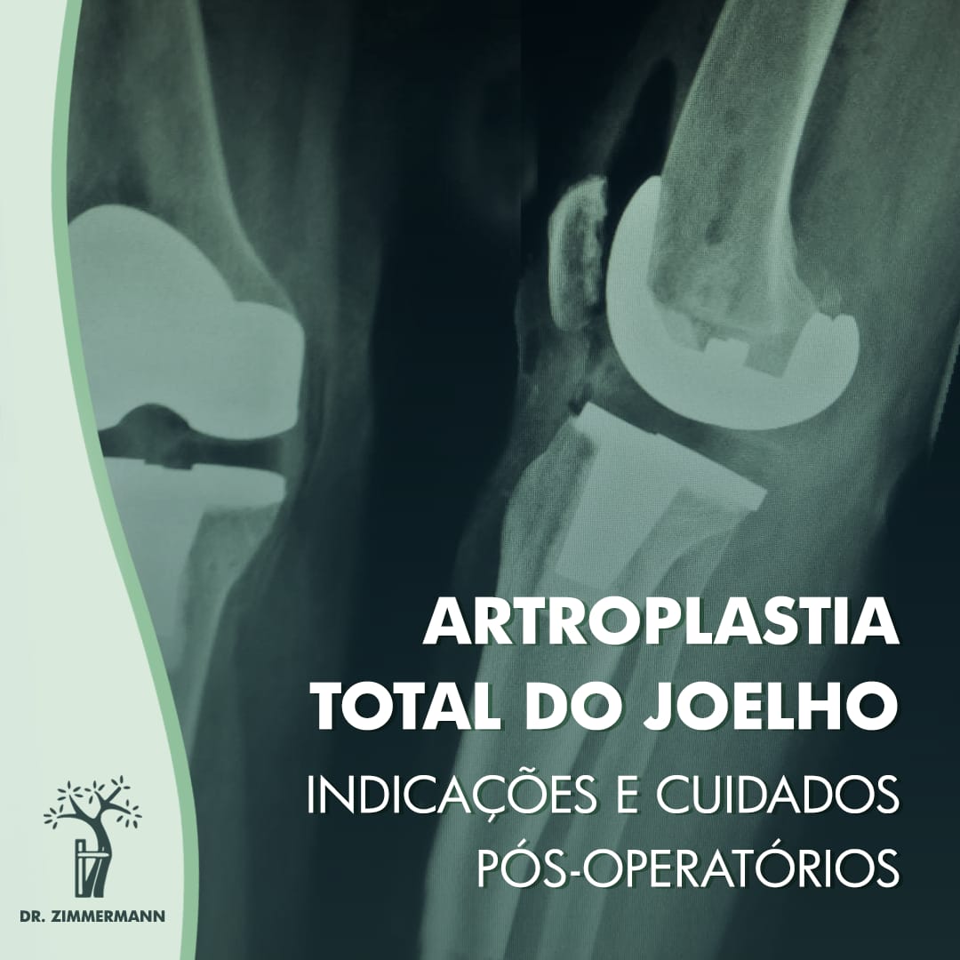 Artroplastia total do joelho: indicações e cuidados pós-operatórios ...